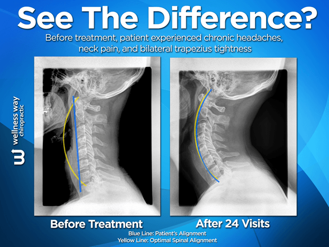 Tech Neck and Scapular Dysfunction: How Jacksonville Office Workers Can Stand Tall Again in 2026 Before and after cervical spine X-ray after chiropractic care