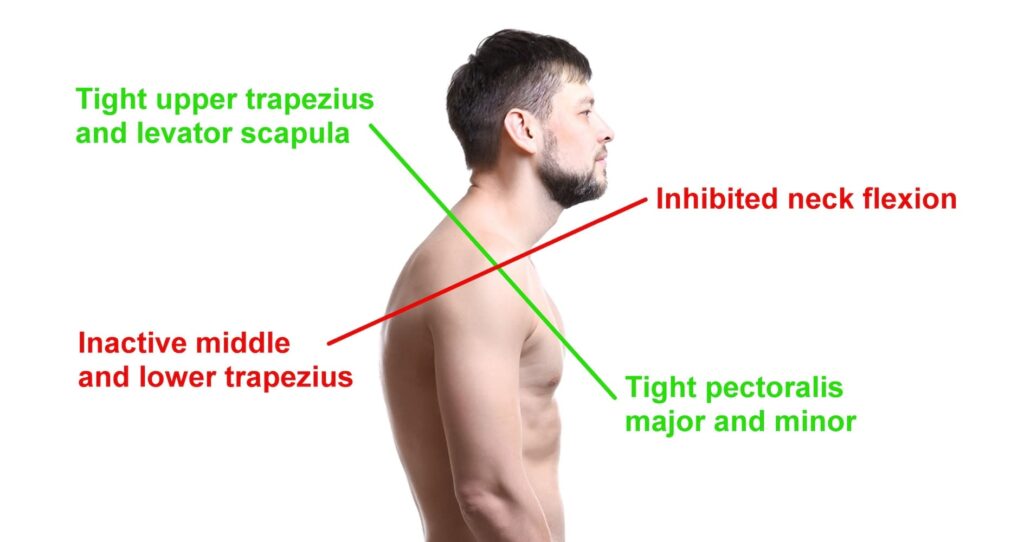 Tech Neck and Scapular Dysfunction: How Jacksonville Office Workers Can Stand Tall Again in 2026 Upper cross syndrome muscle imbalance diagram