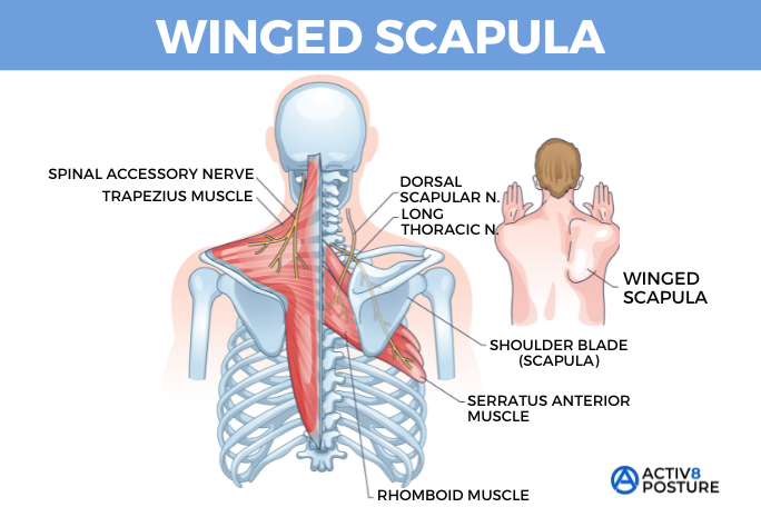 Tech Neck and Scapular Dysfunction: How Jacksonville Office Workers Can Stand Tall Again in 2026 Anatomical diagram of winged scapula and scapular dysfunction